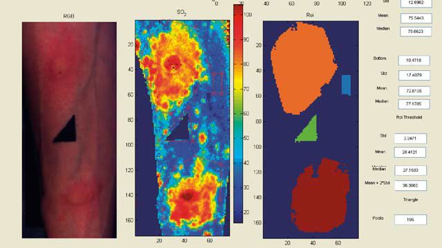 来自诺丁汉大学的高光谱图像，通过将光线照射在组织表面并准确测量氧气水平并生成血氧饱和度图而得出，以方便临床研究人员和医生的工作。